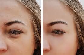 Dark circles under the eyes, hollow eyes and bags under the eyes are problem commonly seen as people age. Under Eye Filler Benefits Of Belotero Grossman Dermatology