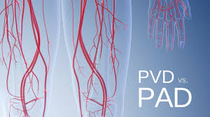 Are Pad And Pvd The Same Disease