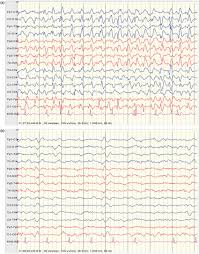A 64 Ys Old Male Patient Epileptic With Sudden Clonazepam