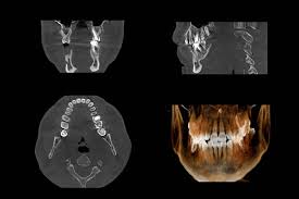 cbct imaging la jolla village endodontics