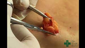 removal of a lipoma from the lower back