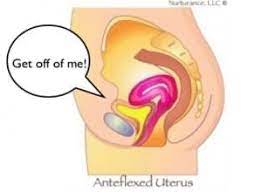 is your anteflexed uterus ing off