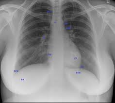 Living anatomy of the chest for 1st year medical students original version compiled by dr. Normal Chest Radiograph Female Radiology Case Radiopaedia Org