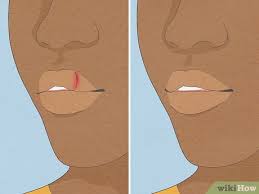 how to treat a cut lip fast first aid