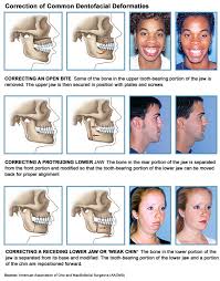 How overbite correction surgery works correcting an overbite depends on the degree of misalignment. Surgical Orthodontics Myorthodontist Vancouver