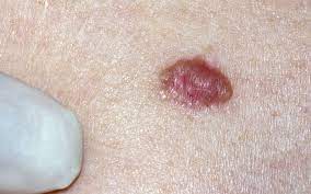 spot skin cancer early
