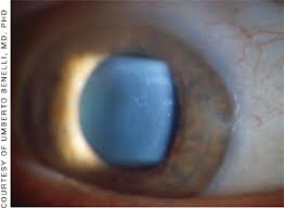 You are here the epithelium can have cloudy areas that resemble continents on a map, as well as opaque dots. Contact Lens Spectrum Diagnosing And Treating Corneal Dystrophy