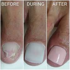toenail restoration service the