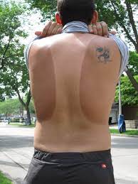 File:Tan Lines on human male back.jpg - Wikimedia Commons