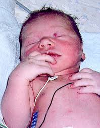 newborn breathing conditions