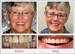 Dentures may feel a bit strange to begin with, but you'll soon get used. Dentures Dental Excellence