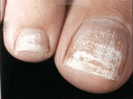 dry painful toenail or fingernails