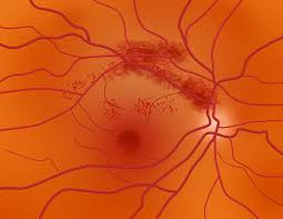 retinal artery and retinal vein occlusions