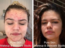 effective acne treatment program pure
