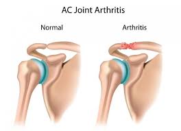Shoulder Acromioclavicular Ac Joint