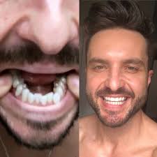 After about a year of wearing them at night, i let people know that now it's your turn to be an orthodontist. Byteme Reviews Our Honest Comparison Smileodontics Com