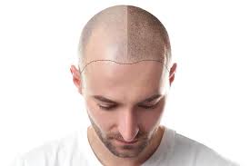 Free transportation from san diego airport. Top 10 Best Hair Transplant In Chicago Cost Treatment Reviews Best Doctors Usa Top Hospitals Usa Nt Directory Usa