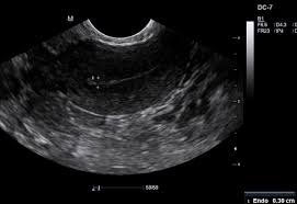 Endometrial Thickness Radiology Reference Article