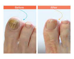 understandign toenail fungus in