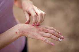 intrinsic eczema symptoms causes and