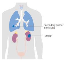 Kidney Cancer Symptoms Diagnosis Treatment Urology