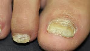 derm dx thickened toenails clinical