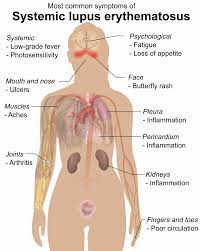 lupus symptoms causes and treatments