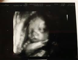 possible cleft lip ultrasound picture