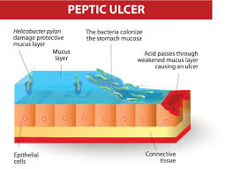 peptic ulcers and h pylori