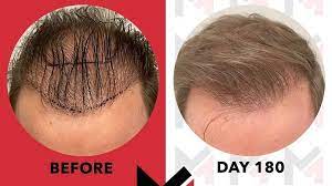 stem cell hair therapy re growth