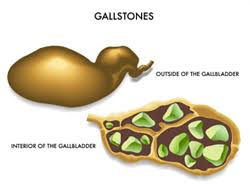 Gallstones Treatment London Uk Laparoscopic Gallbladder