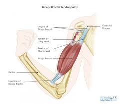 biceps brachii tendinopathy rehab my