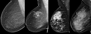 Breast Density Are You Informed Imaging Technology News