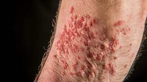 mold rash causes symptoms and