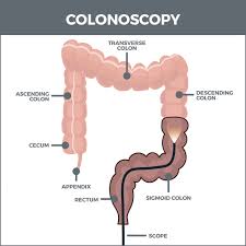 colonoscopy gastro md