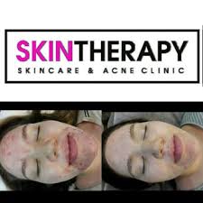 skintherapy skincare acne clinic 40