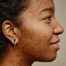 scar management on black skin