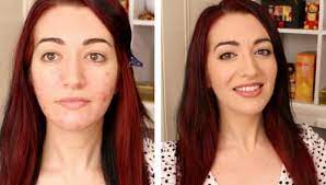 applying makeup on acne e skin