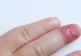 clinic in meerut nail disorders