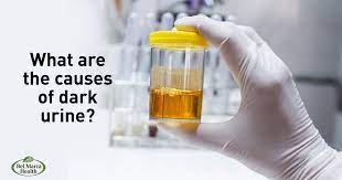 common causes of dark urine treatment