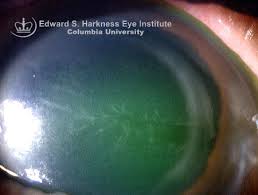 Anterior or superficial corneal they include: Pseudodendrite Columbia Ophthalmology
