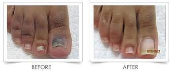 nail fungus treatment in the dalles or