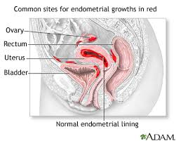 Endometriosis is the abnormal growth of endometrial cells outside the uterus. Endometriosis Medlineplus Medical Encyclopedia