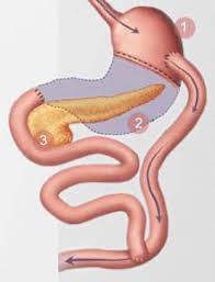 gastric byp surgery how to avoid