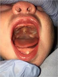 cavity in newborns