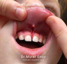 upper lip tie tear injury