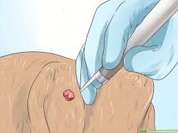 how to remove warts on dogs at home