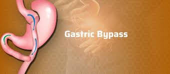 gastric byp