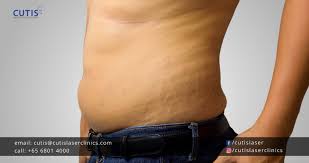 stretch marks in men causes