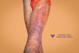varicose veins and inflammation
